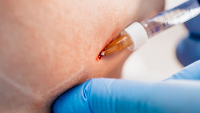 Intradermal injections